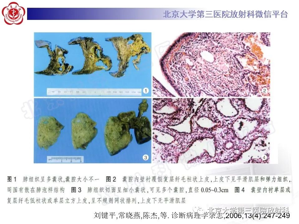 影像PPT - 【PPT】先天性肺囊性腺瘤样畸形-13