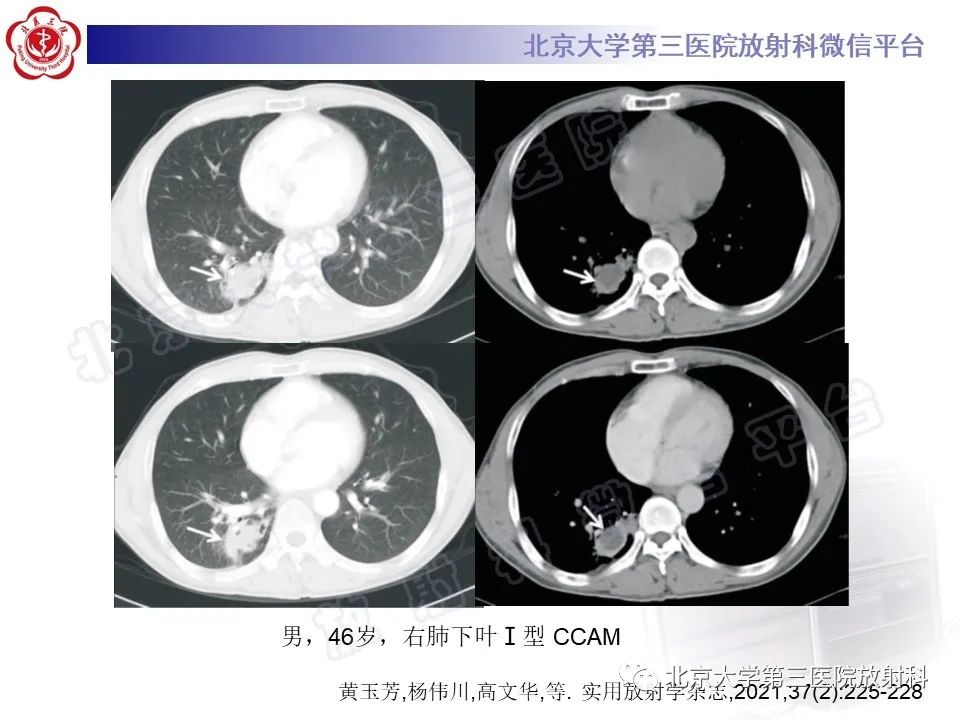 影像PPT - 【PPT】先天性肺囊性腺瘤样畸形-18