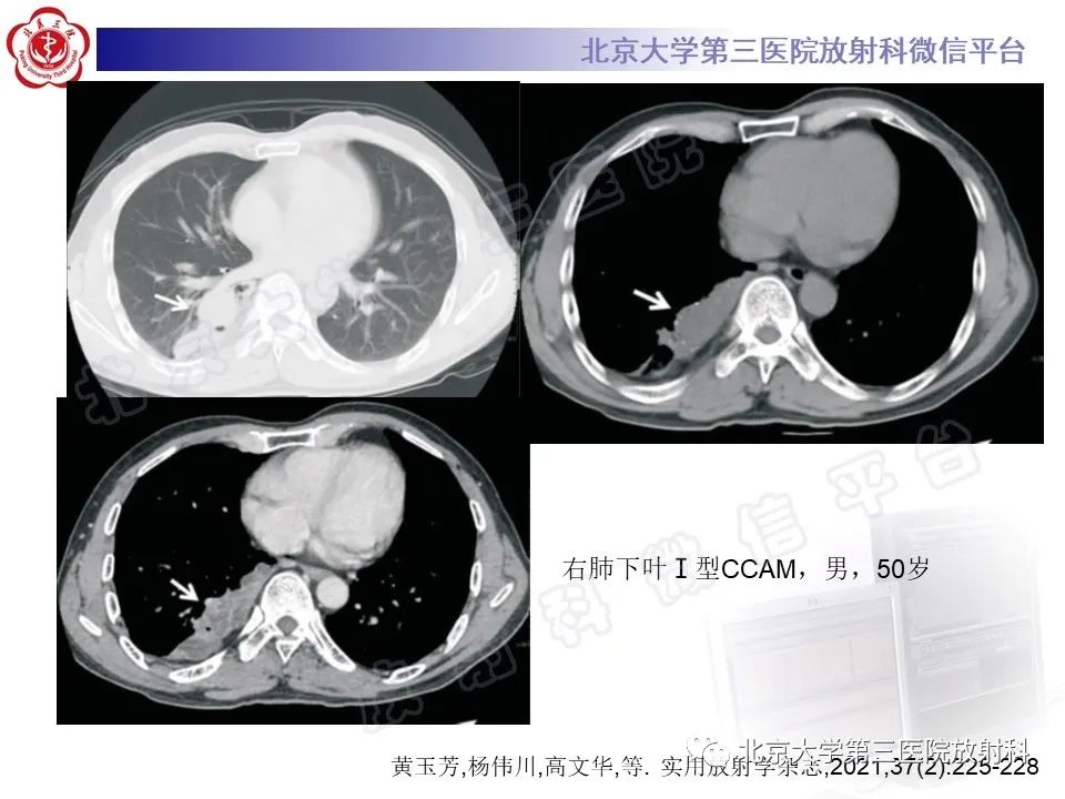 影像PPT - 【PPT】先天性肺囊性腺瘤样畸形-19