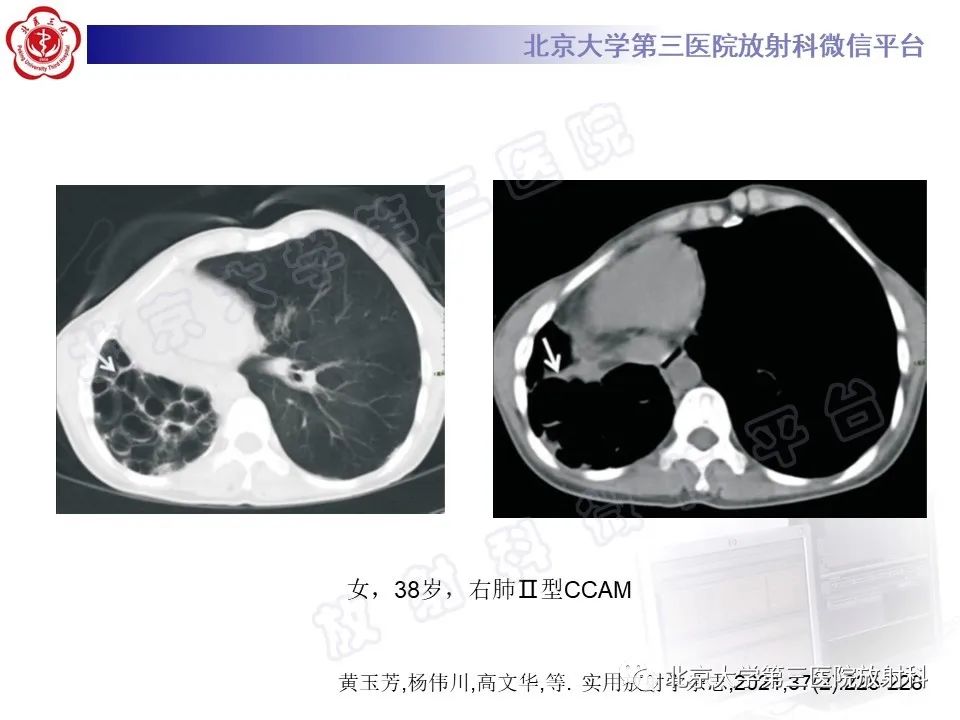 影像PPT - 【PPT】先天性肺囊性腺瘤样畸形-20