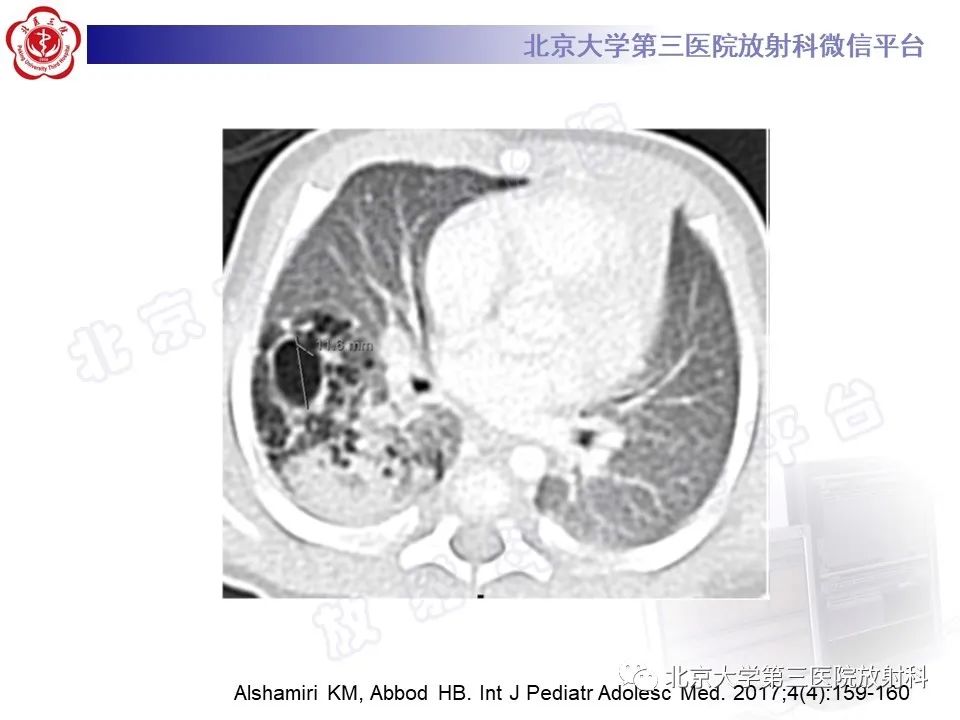 影像PPT - 【PPT】先天性肺囊性腺瘤样畸形-21