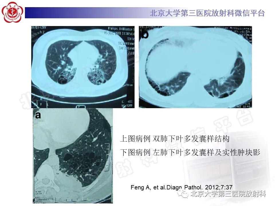影像PPT - 【PPT】先天性肺囊性腺瘤样畸形-22
