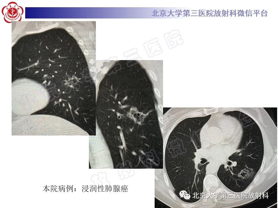 影像PPT - 【PPT】先天性肺囊性腺瘤样畸形-25