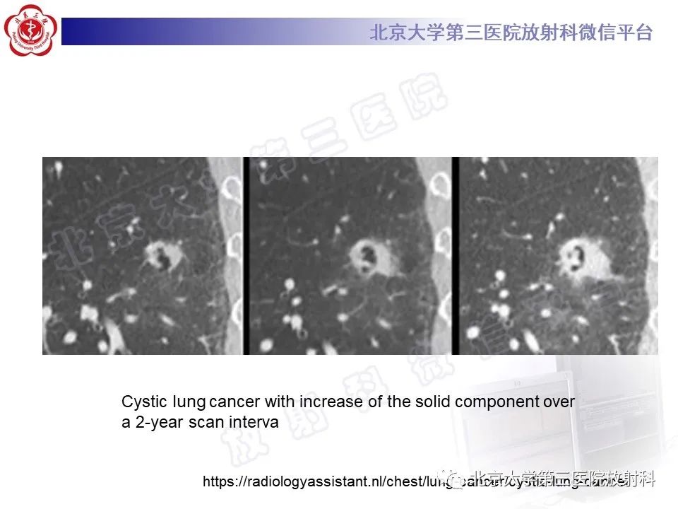 影像PPT - 【PPT】先天性肺囊性腺瘤样畸形-26