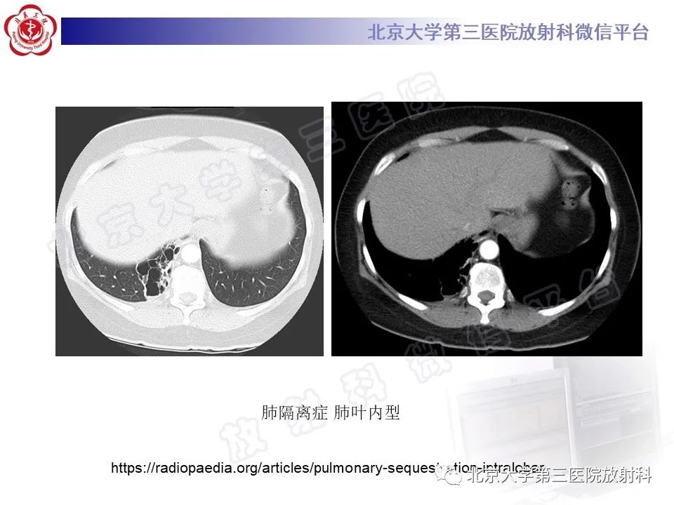 影像PPT - 【PPT】先天性肺囊性腺瘤样畸形-28