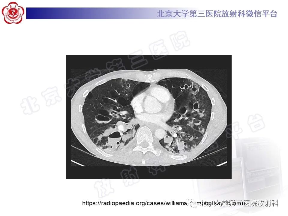 影像PPT - 【PPT】先天性肺囊性腺瘤样畸形-30