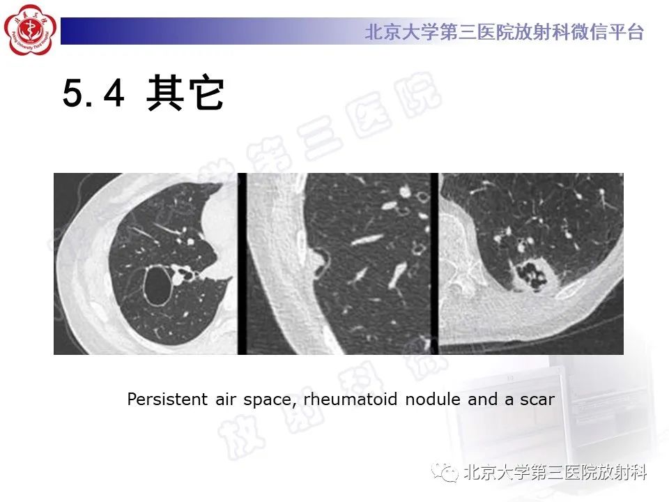 影像PPT - 【PPT】先天性肺囊性腺瘤样畸形-32