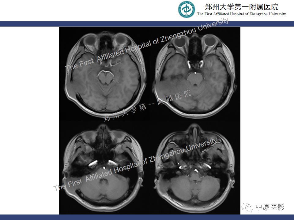 影像PPT - 【病例】颅骨骨肉瘤1例MR影像-3