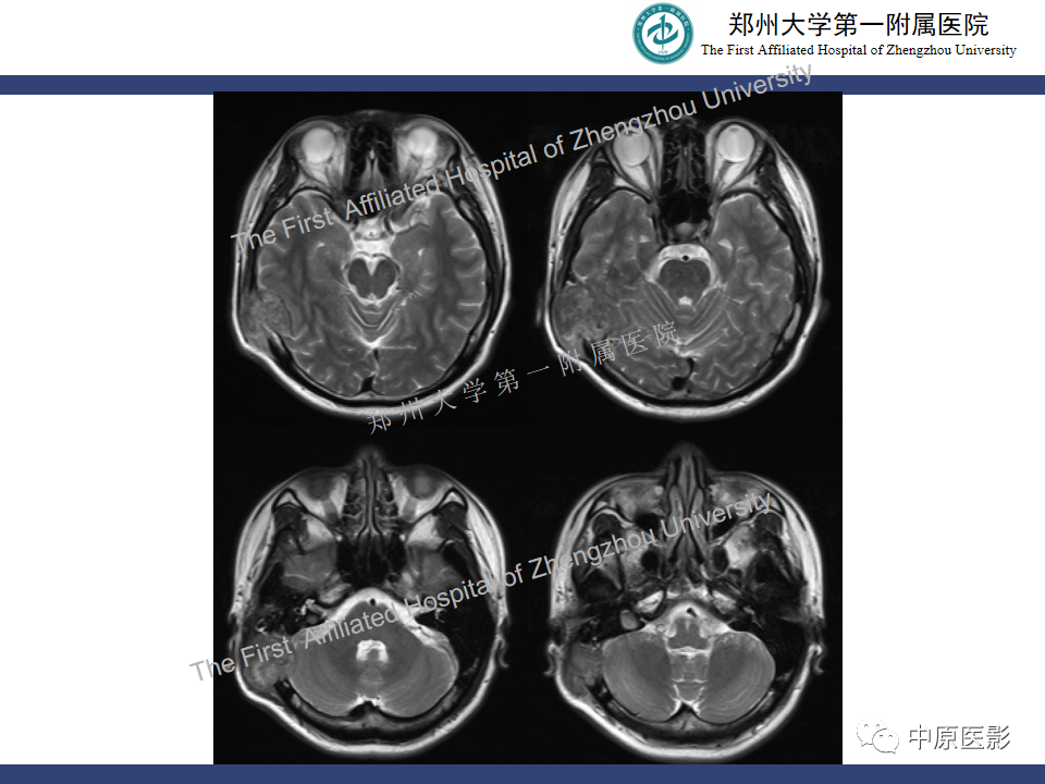 影像PPT - 【病例】颅骨骨肉瘤1例MR影像-4