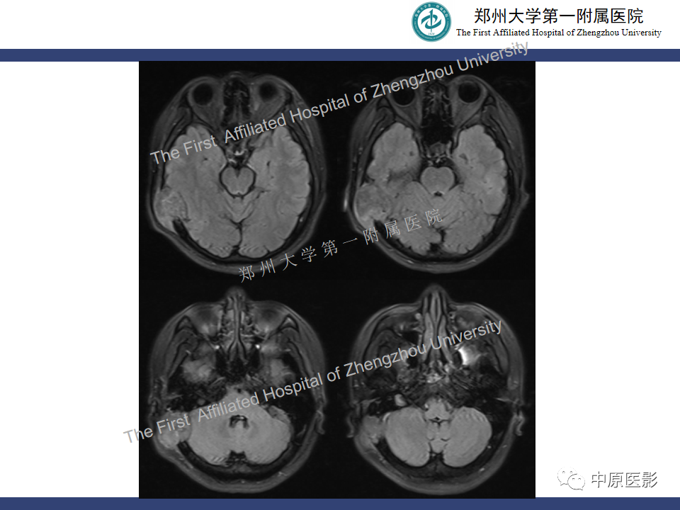 影像PPT - 【病例】颅骨骨肉瘤1例MR影像-5