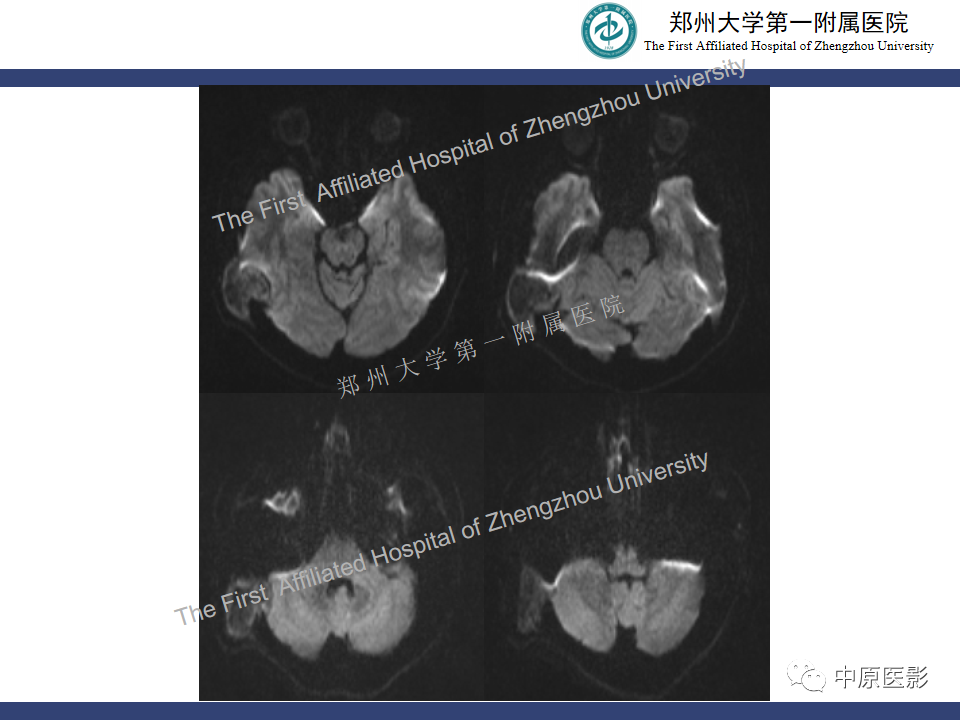 影像PPT - 【病例】颅骨骨肉瘤1例MR影像-6