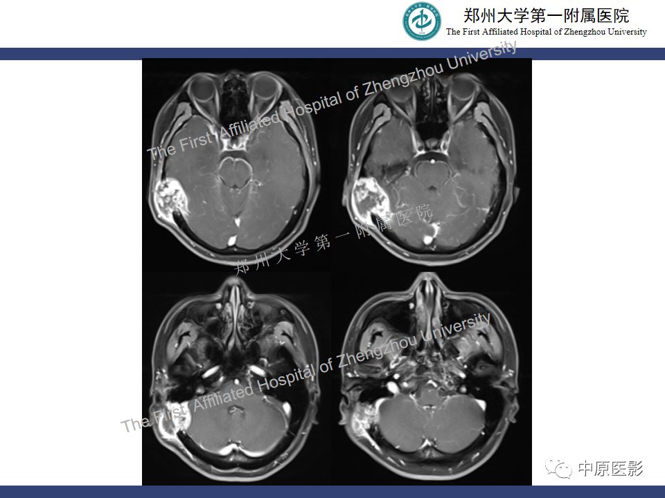 影像PPT - 【病例】颅骨骨肉瘤1例MR影像-7