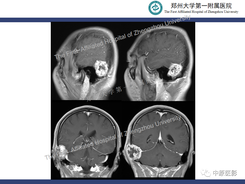 影像PPT - 【病例】颅骨骨肉瘤1例MR影像-8