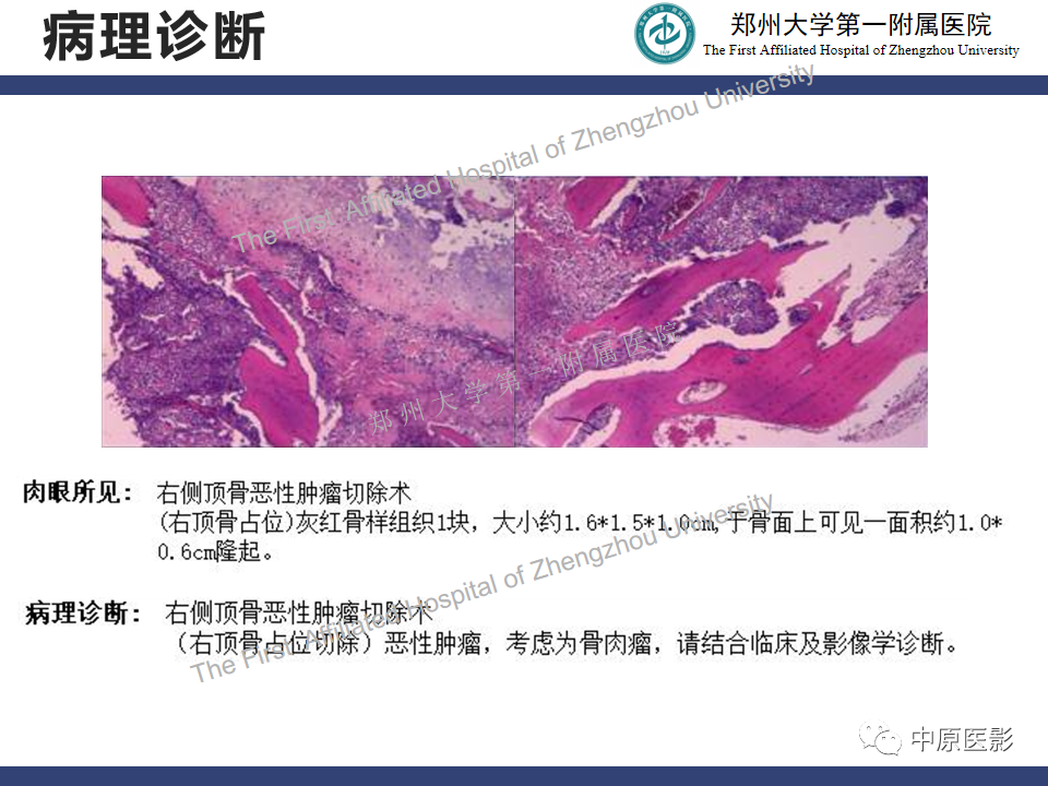 影像PPT - 【病例】颅骨骨肉瘤1例MR影像-11
