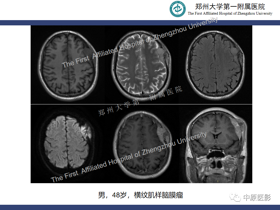 影像PPT - 【病例】颅骨骨肉瘤1例MR影像-17