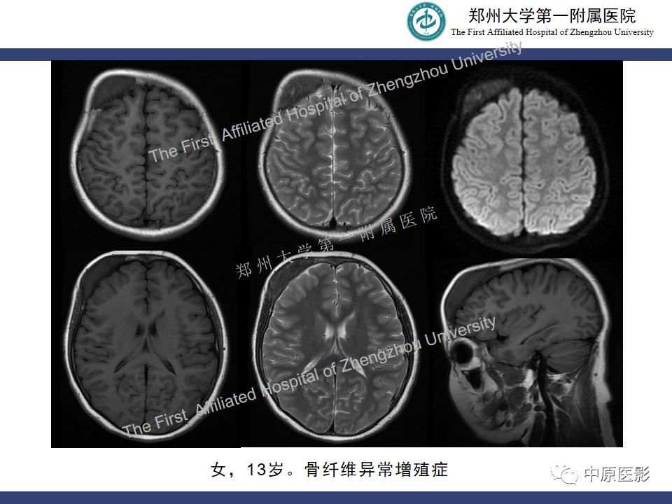 影像PPT - 【病例】颅骨骨肉瘤1例MR影像-19