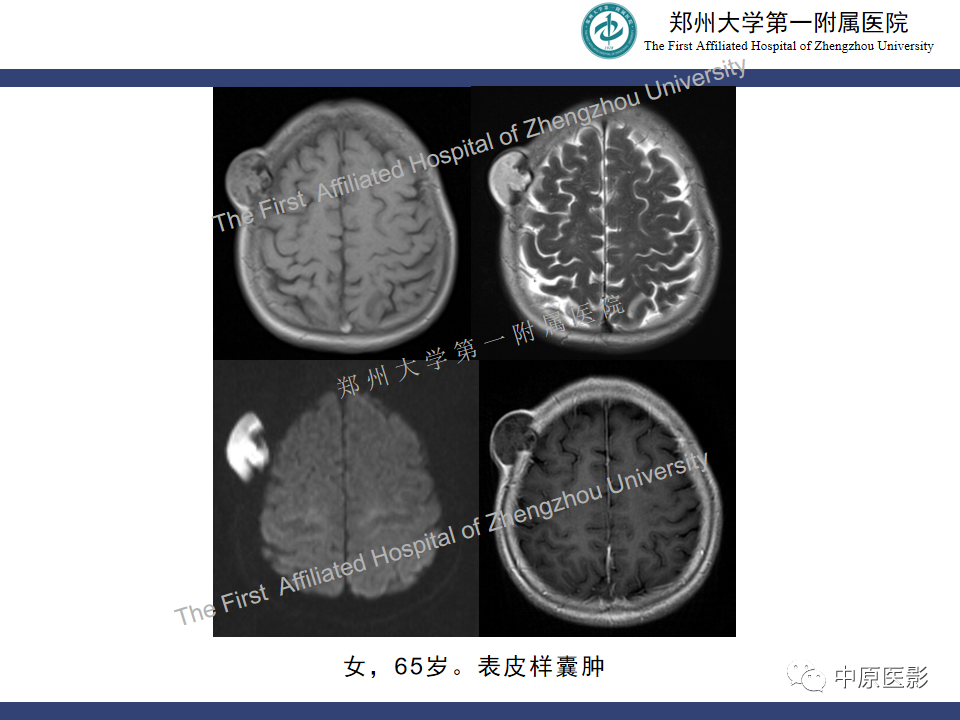 影像PPT - 【病例】颅骨骨肉瘤1例MR影像-21