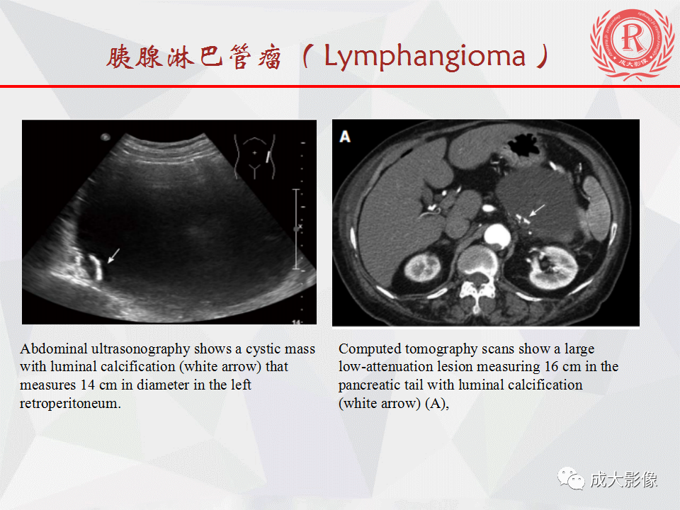 影像PPT - 【PPT】胰腺良性间叶源性肿瘤影像诊断-11
