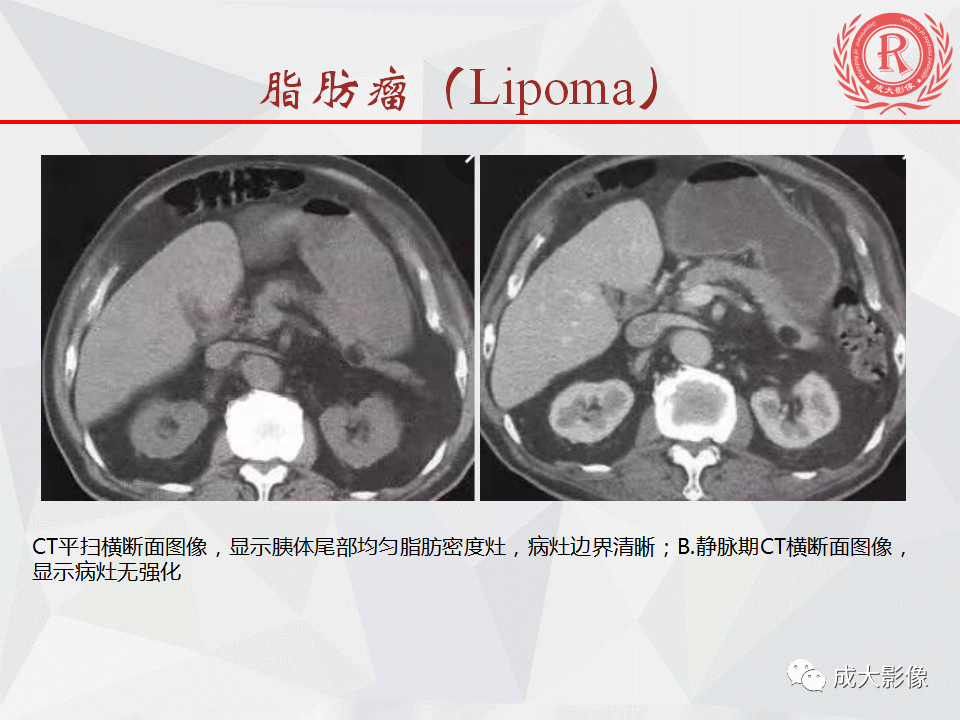 影像PPT - 【PPT】胰腺良性间叶源性肿瘤影像诊断-17