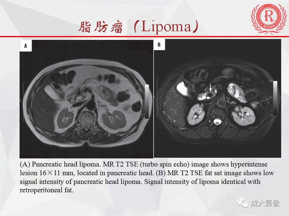 影像PPT - 【PPT】胰腺良性间叶源性肿瘤影像诊断-19