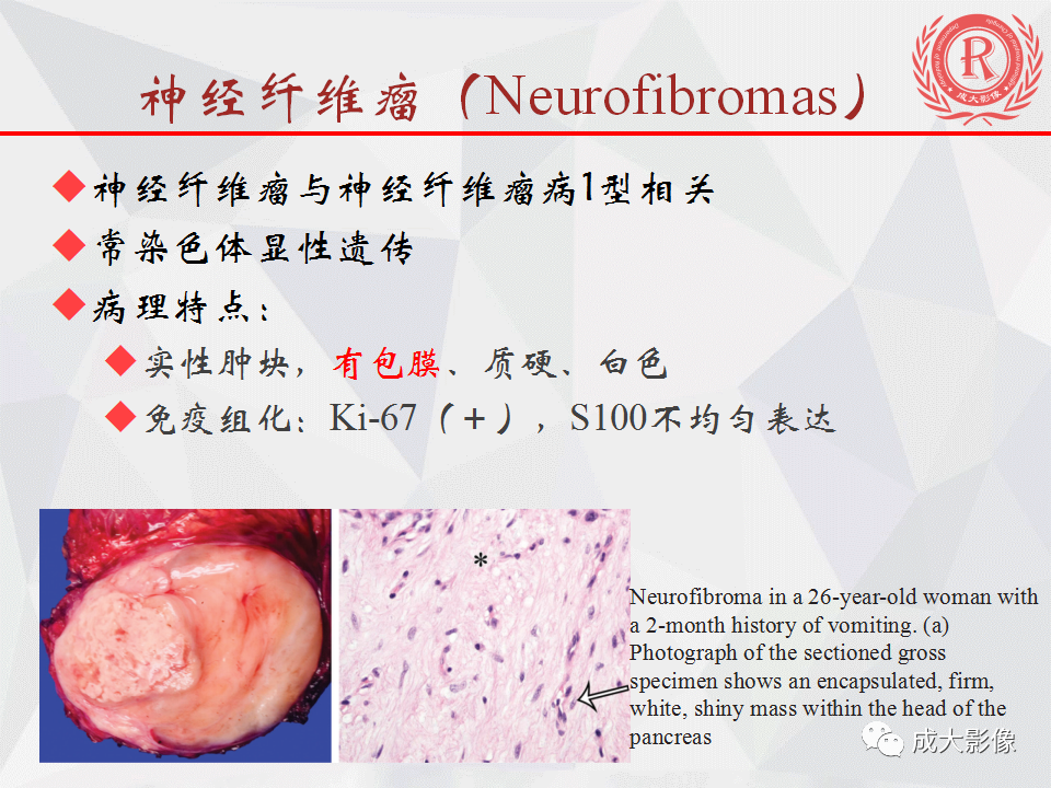 影像PPT - 【PPT】胰腺良性间叶源性肿瘤影像诊断-23