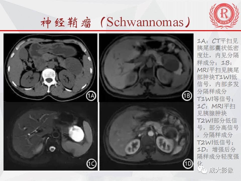 影像PPT - 【PPT】胰腺良性间叶源性肿瘤影像诊断-31