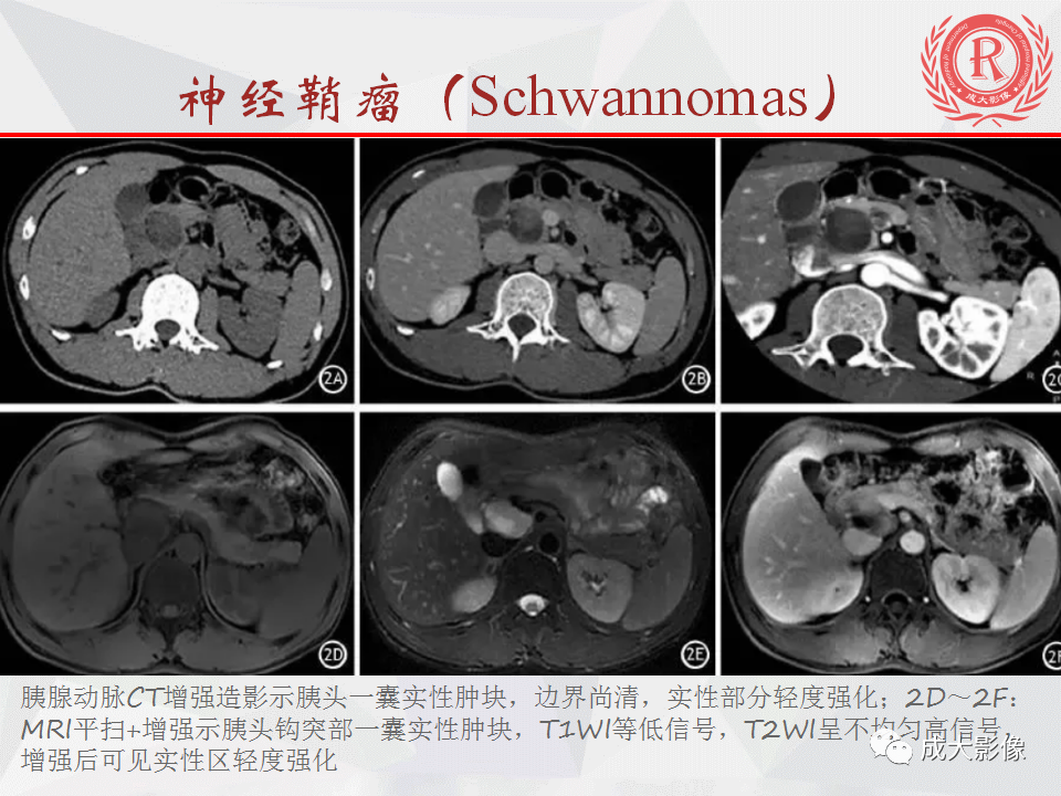 影像PPT - 【PPT】胰腺良性间叶源性肿瘤影像诊断-32
