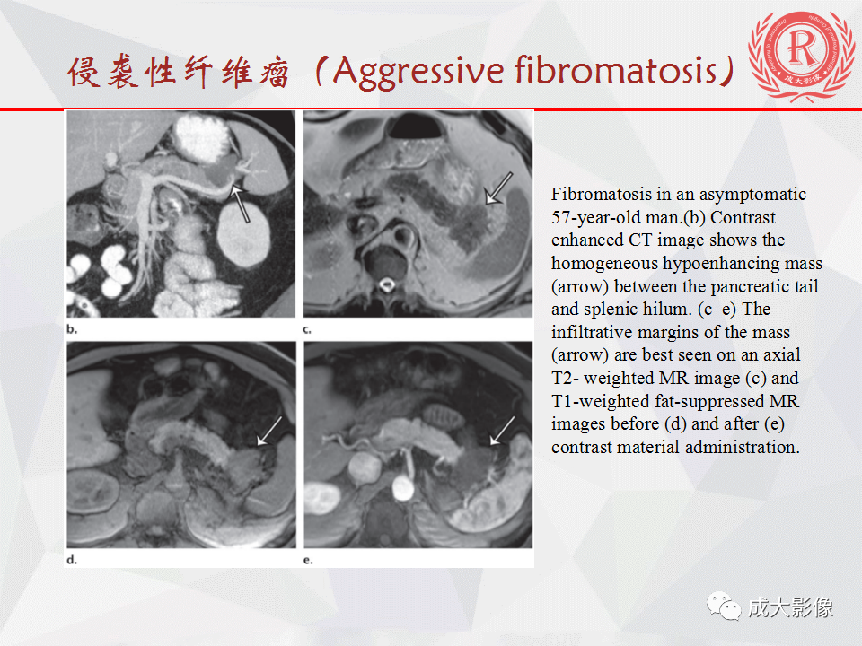 影像PPT - 【PPT】胰腺良性间叶源性肿瘤影像诊断-42