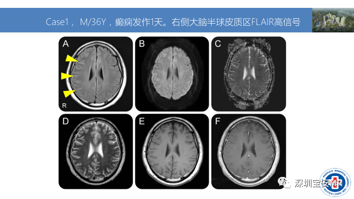 影像PPT - 【PPT】MOG抗体阳性单侧皮质脑炎的影像诊断及鉴别诊断-5