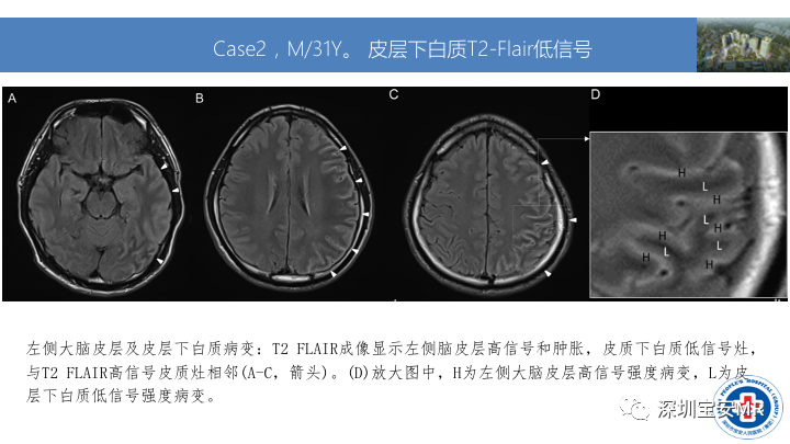 影像PPT - 【PPT】MOG抗体阳性单侧皮质脑炎的影像诊断及鉴别诊断-6