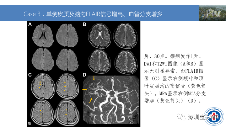 影像PPT - 【PPT】MOG抗体阳性单侧皮质脑炎的影像诊断及鉴别诊断-7