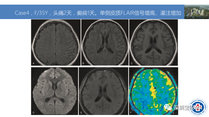 影像PPT - 【PPT】MOG抗体阳性单侧皮质脑炎的影像诊断及鉴别诊断-8
