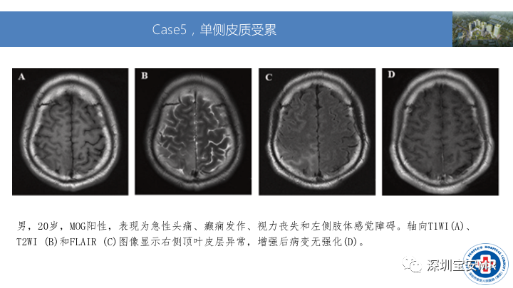 影像PPT - 【PPT】MOG抗体阳性单侧皮质脑炎的影像诊断及鉴别诊断-9