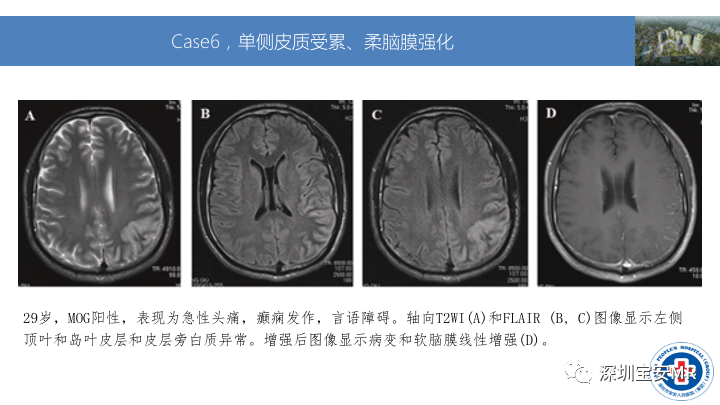 影像PPT - 【PPT】MOG抗体阳性单侧皮质脑炎的影像诊断及鉴别诊断-10