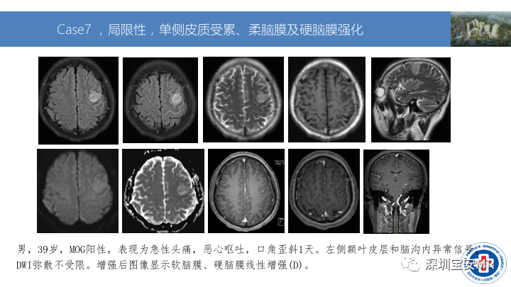 影像PPT - 【PPT】MOG抗体阳性单侧皮质脑炎的影像诊断及鉴别诊断-11