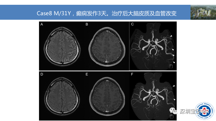 影像PPT - 【PPT】MOG抗体阳性单侧皮质脑炎的影像诊断及鉴别诊断-12