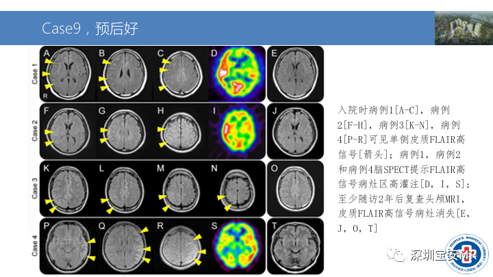 影像PPT - 【PPT】MOG抗体阳性单侧皮质脑炎的影像诊断及鉴别诊断-13