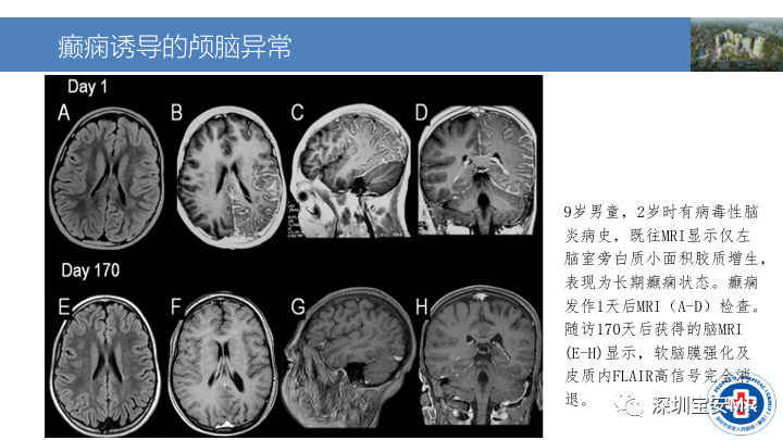 影像PPT - 【PPT】MOG抗体阳性单侧皮质脑炎的影像诊断及鉴别诊断-16
