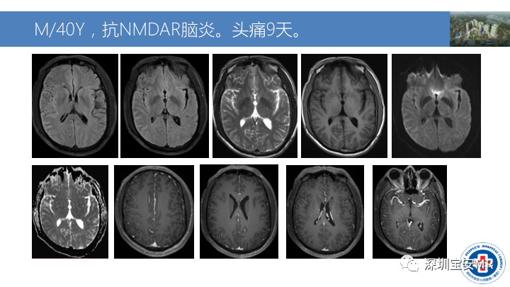影像PPT - 【PPT】MOG抗体阳性单侧皮质脑炎的影像诊断及鉴别诊断-20