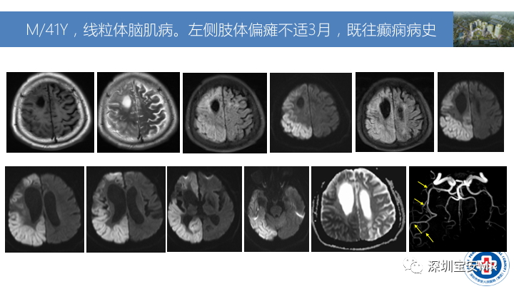 影像PPT - 【PPT】MOG抗体阳性单侧皮质脑炎的影像诊断及鉴别诊断-22