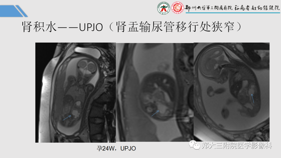 影像PPT - 【PPT】胎儿泌尿生殖系统常见疾病的MRI诊断-16