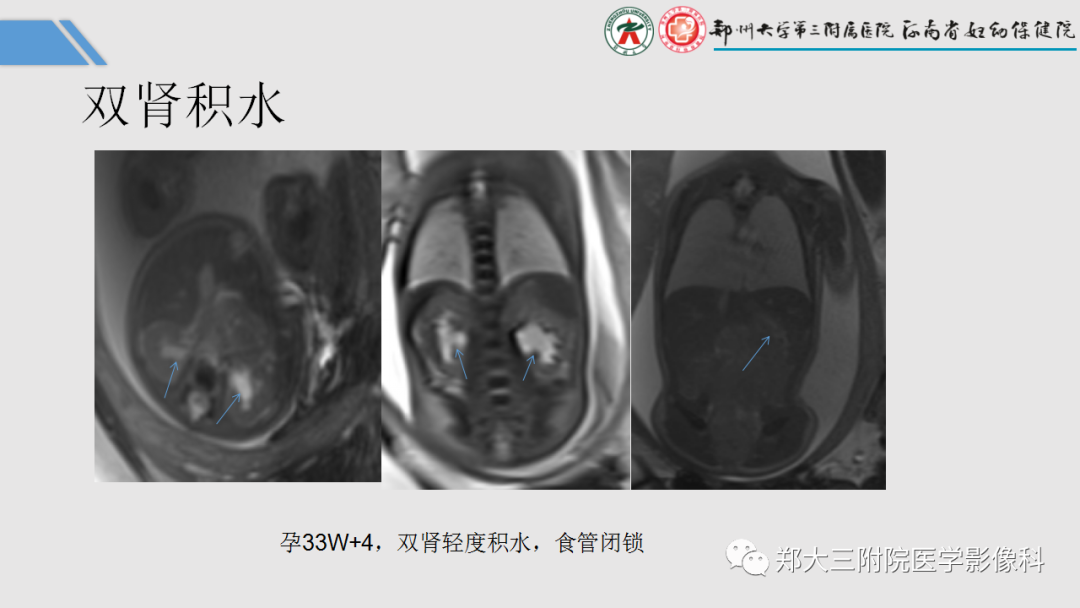 影像PPT - 【PPT】胎儿泌尿生殖系统常见疾病的MRI诊断-15