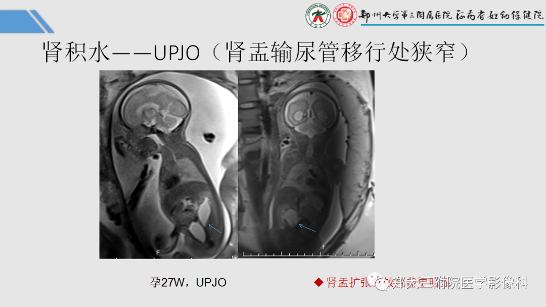 影像PPT - 【PPT】胎儿泌尿生殖系统常见疾病的MRI诊断-17