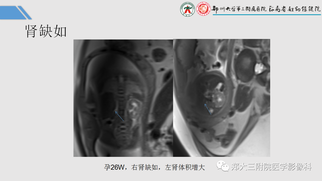 影像PPT - 【PPT】胎儿泌尿生殖系统常见疾病的MRI诊断-20