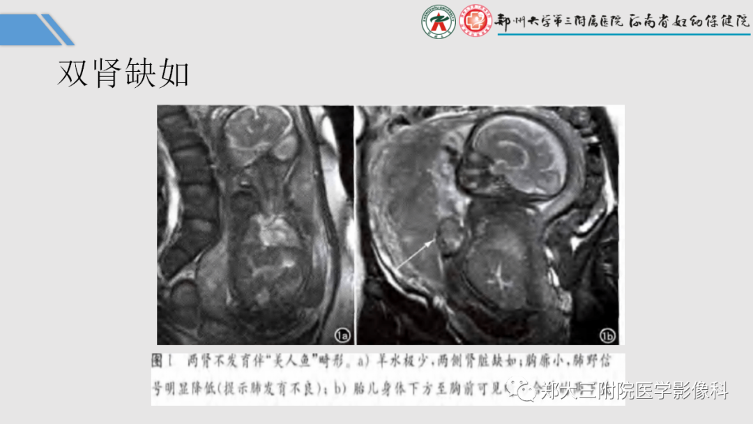 影像PPT - 【PPT】胎儿泌尿生殖系统常见疾病的MRI诊断-21