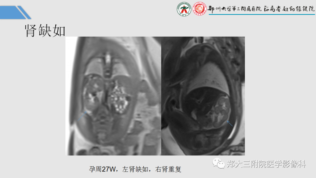 影像PPT - 【PPT】胎儿泌尿生殖系统常见疾病的MRI诊断-22