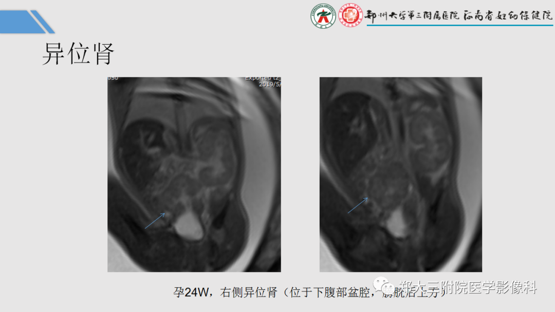 影像PPT - 【PPT】胎儿泌尿生殖系统常见疾病的MRI诊断-24