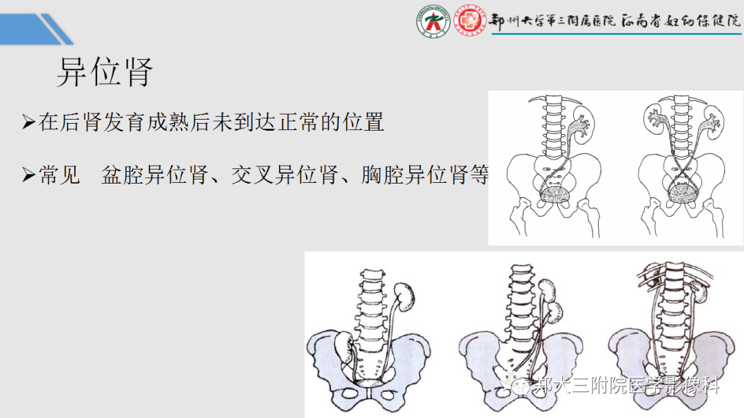 影像PPT - 【PPT】胎儿泌尿生殖系统常见疾病的MRI诊断-23