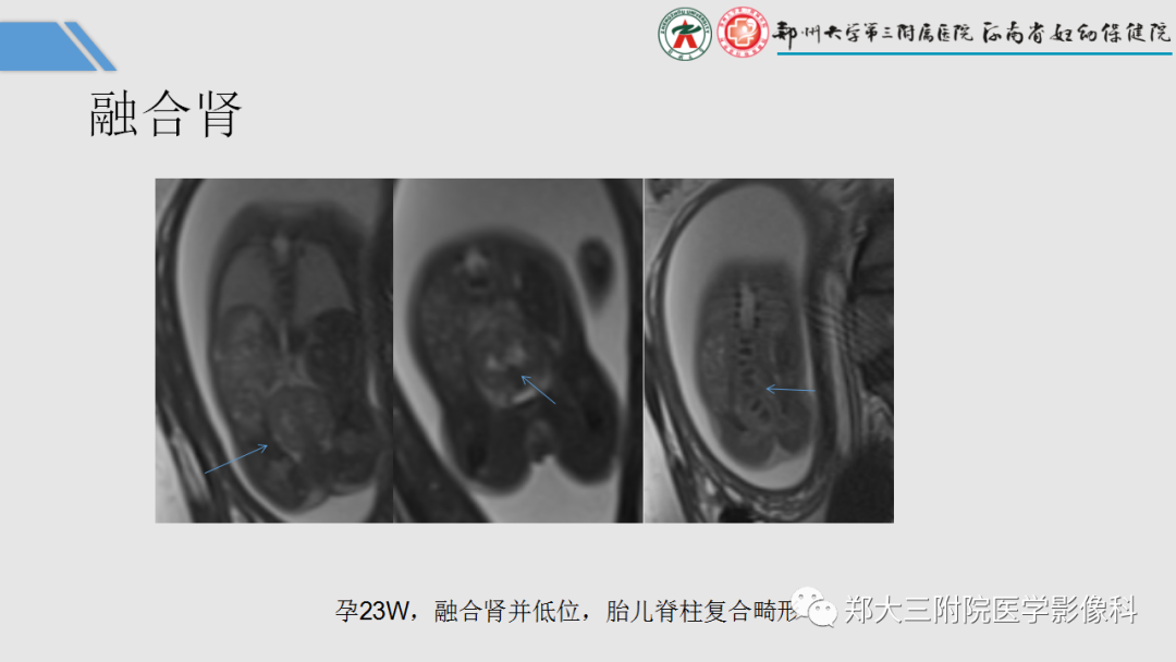 影像PPT - 【PPT】胎儿泌尿生殖系统常见疾病的MRI诊断-26