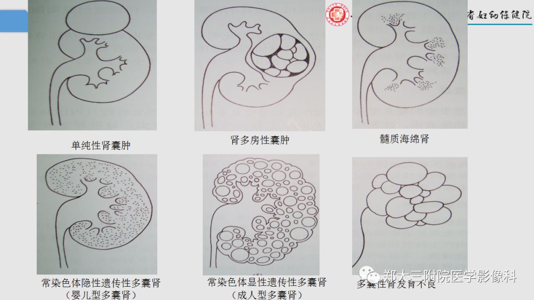 影像PPT - 【PPT】胎儿泌尿生殖系统常见疾病的MRI诊断-28